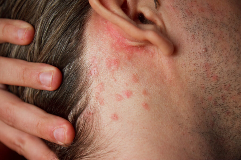 18 Acute Skin Rashes for Nurses to Know (with pictures)