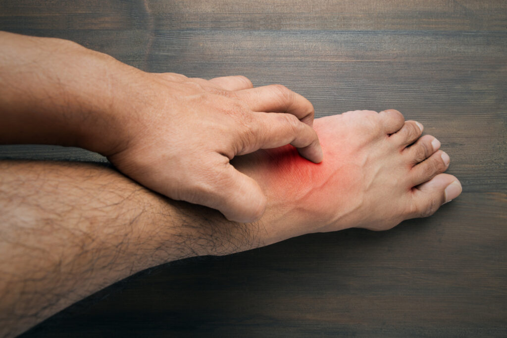 Burning Feet Causes Diagnosis And Treatment 1370