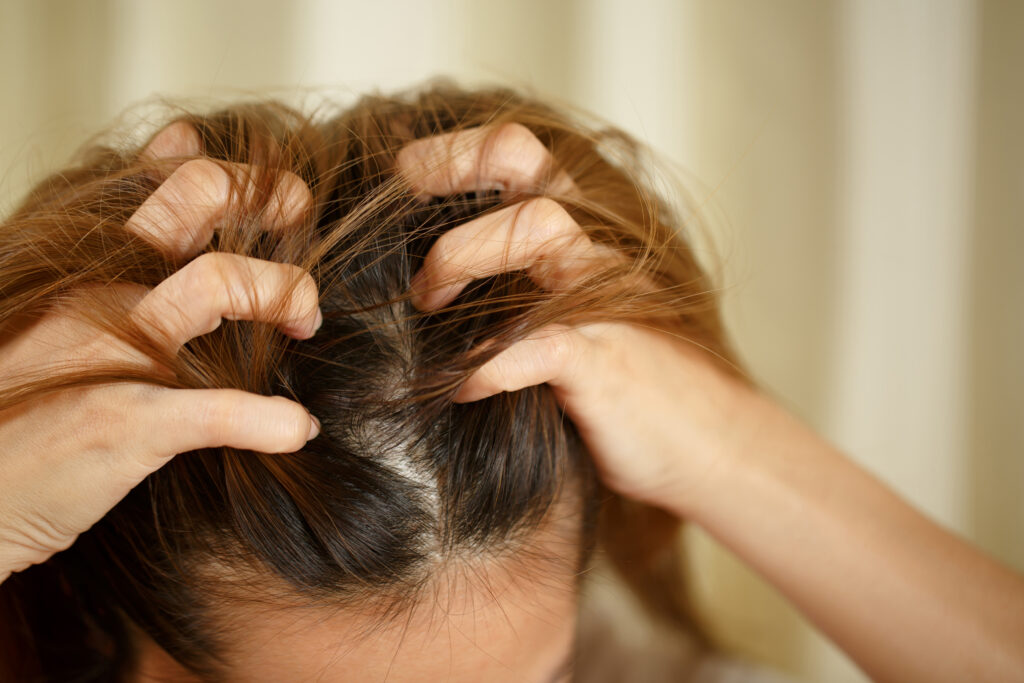 Woman scratching itchy psoriasis on scalp