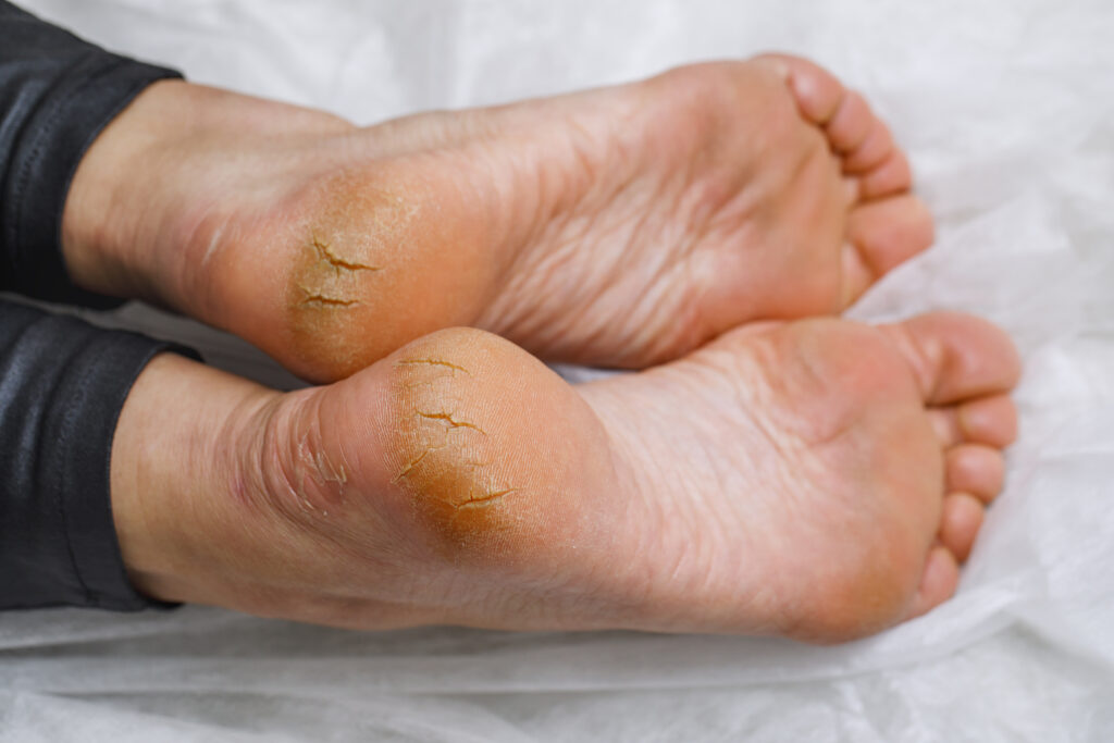 Understanding Cracked Heels: Causes | Scholl UK