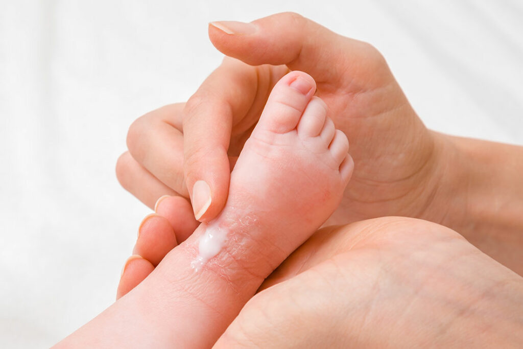 Dry skin in babies and children